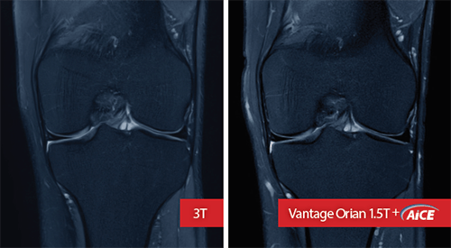 3T vs. Vantage Orian 1.5T+AiCE